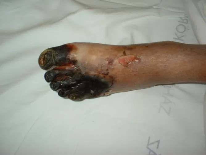 Száraz üszkösödés