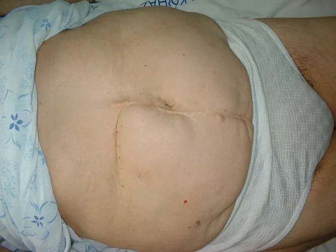 Többször műtött hasfali sérv