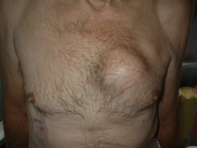 Tüdőrák, ami áttört a mellkasfalon