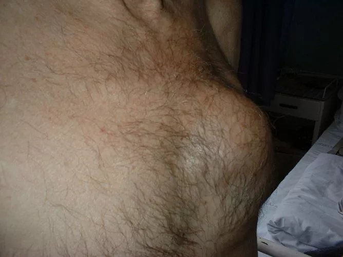 Tüdőrák, ami áttört a mellkasfalon