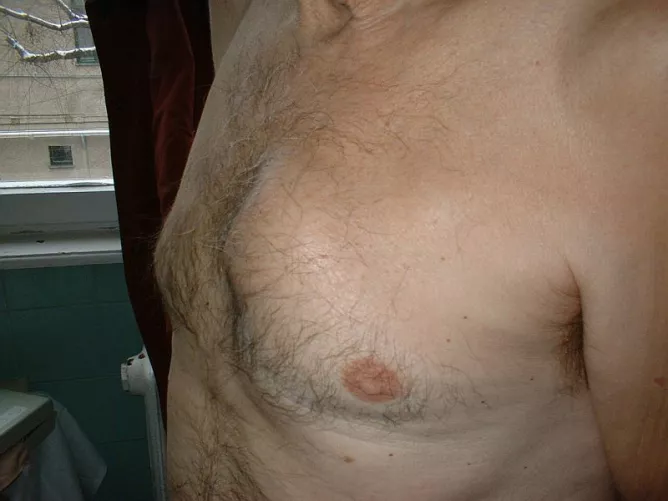 Tüdőrák, ami áttört a mellkasfalon