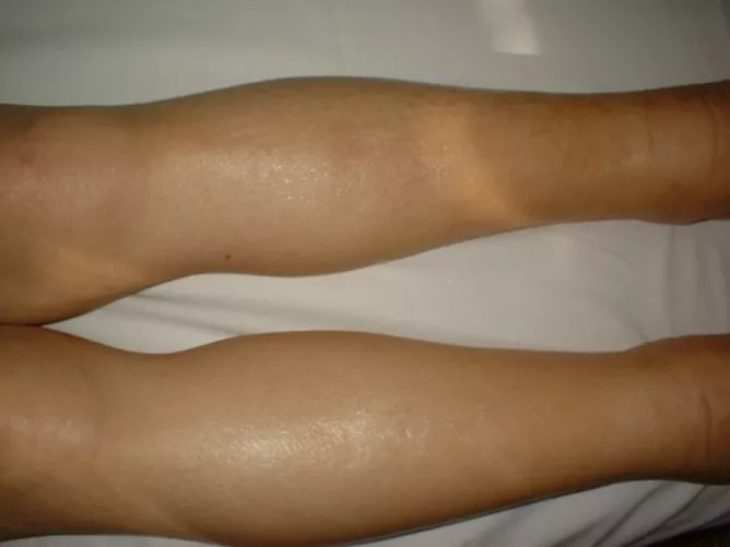 Vizenyő a lábszárakon szívelégtelenségben