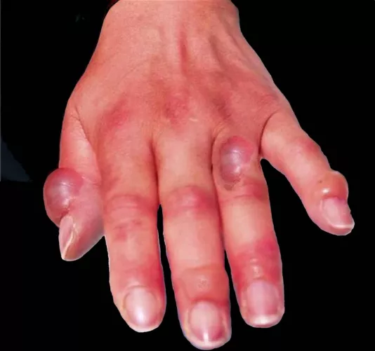 Fagyási sérülés kézen