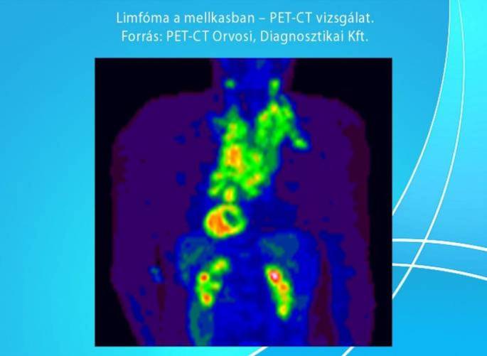 Limfóma a mellkasban (PET-CT)