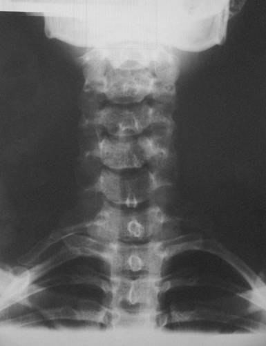 Nyaki borda röntgenfelvételen