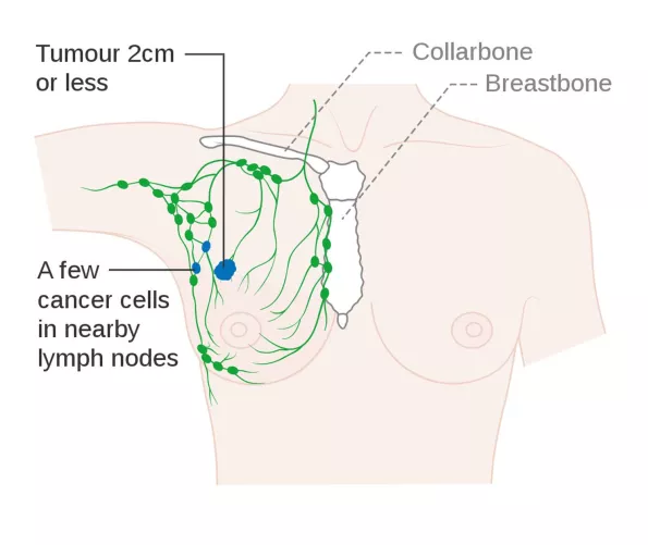 Emlőrák 1B stádiuma sematikus rajzon