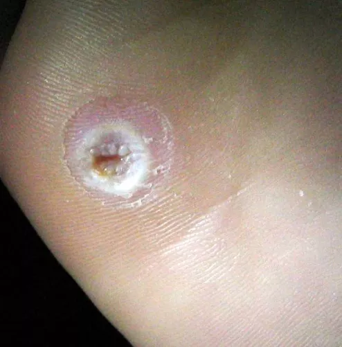 Talpi szemölcs fészke kiemelés után