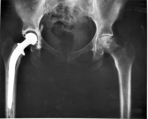 Röntgenfelvétel csípőízületi implantátumról