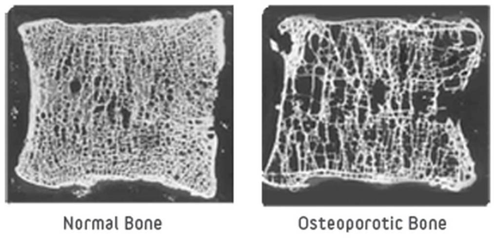 Normál és porotikus csontszövet képe