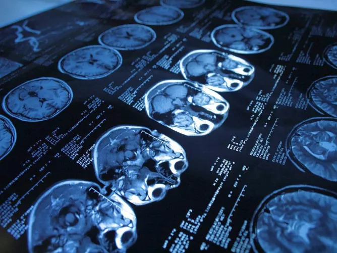 CT felvétel, csak koponya