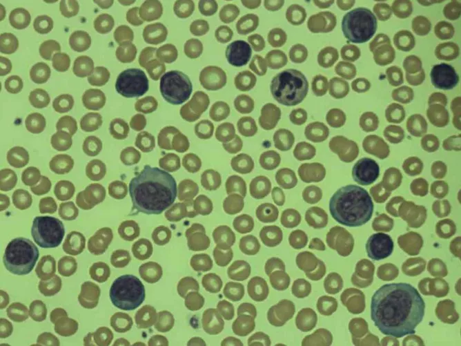 Fehérvérsejtek (limfoblasztok) mikroszkópos képe