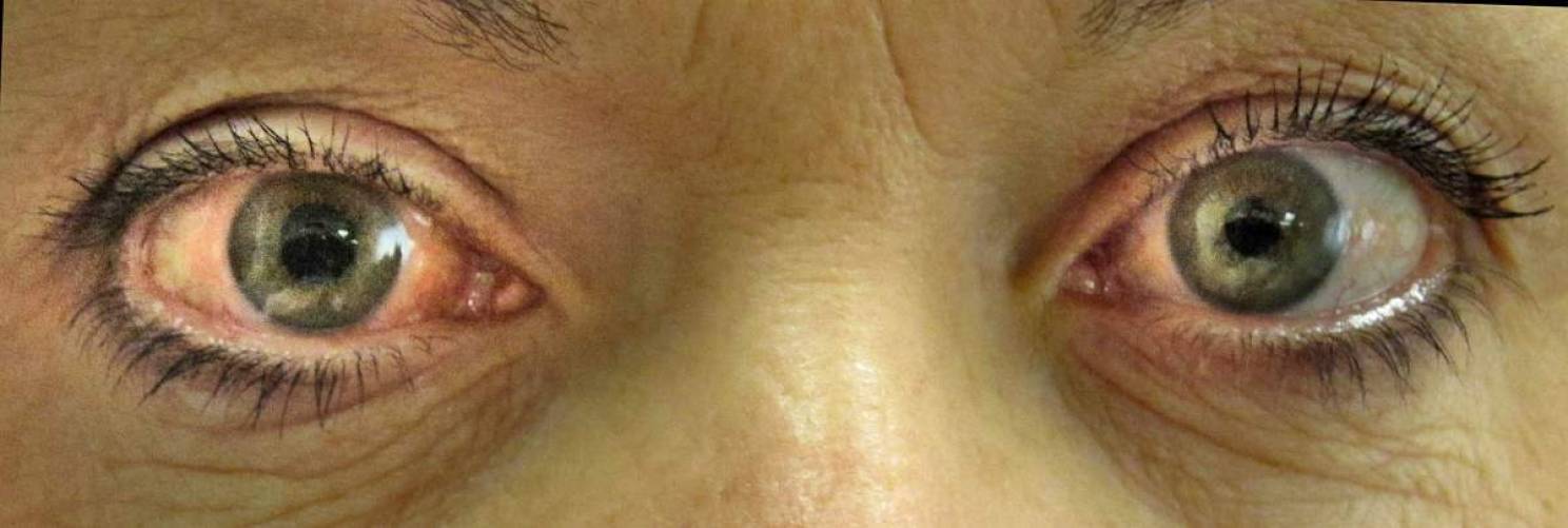 Glaukómás szem
