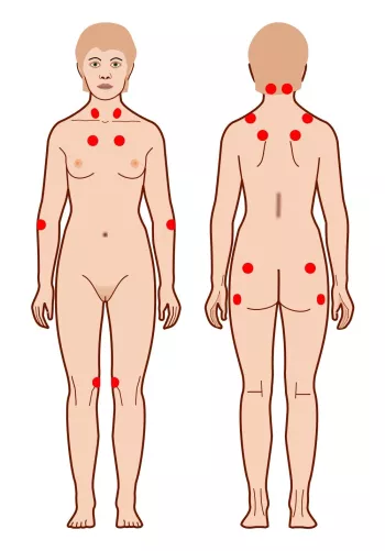 Fájdalmas pontok jelölése.