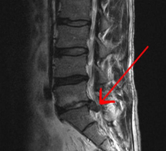 Lumbális gerincsérv MRI-felvételen