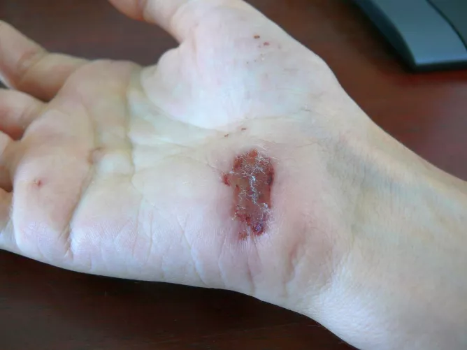 Gyógyuló seb tenyéren