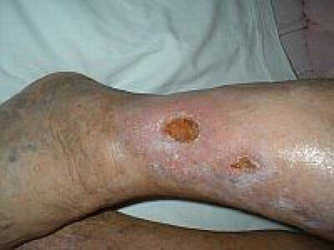 Fotó visszér fekélyek a lábakon. A lábszárfekély fajtái és tünetei
