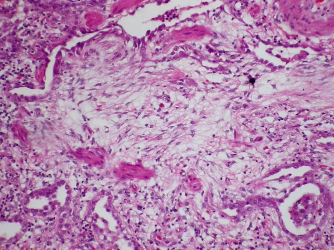 Az elváltozás tüdőszöveti mikroszkópos képe