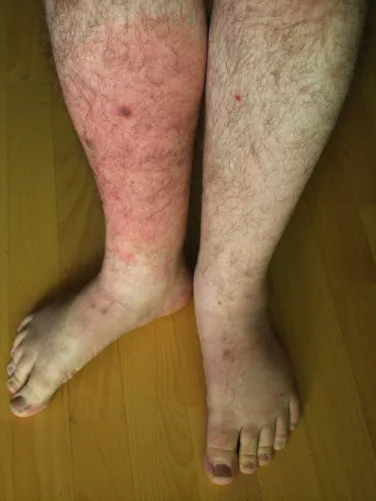 Orbánc a lábszáron, kifejezett bőrvörösödéssel