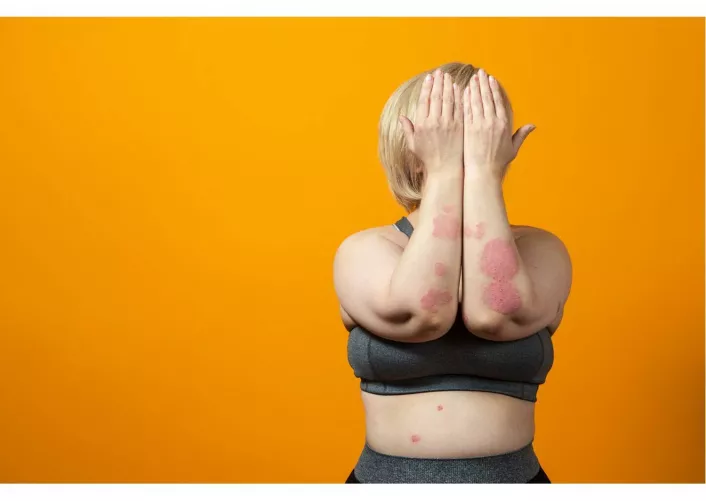 Pikkelysömör bőrön