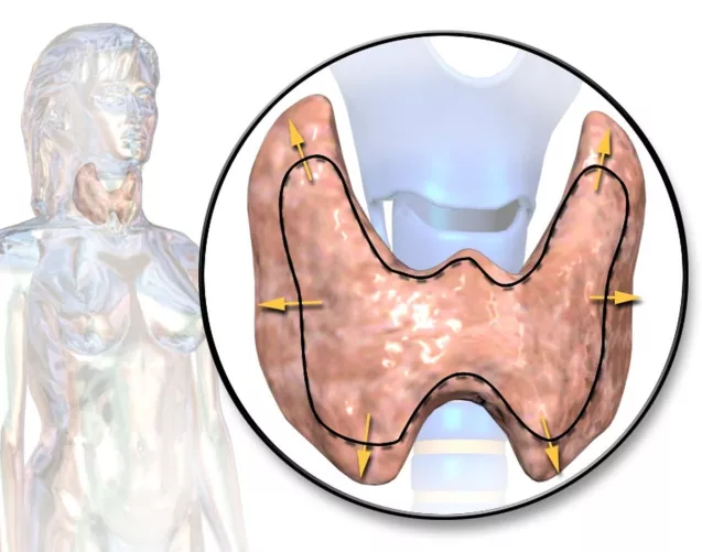 Pajzsmirigy túltengés rajzos illusztrációja