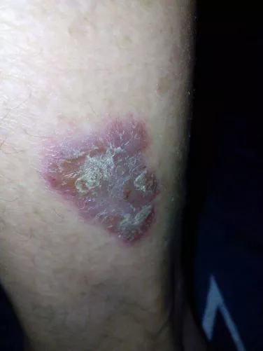 Pikkelysömör képe lábon