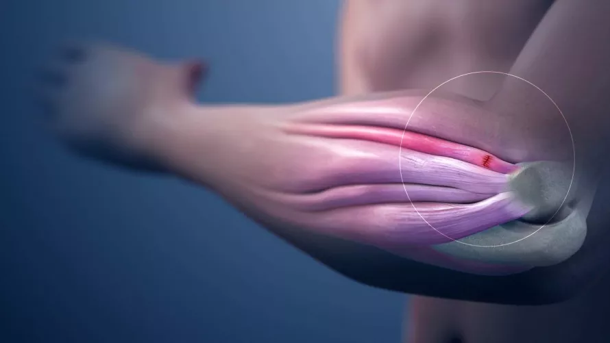Tendinitis számítógépes illusztráció