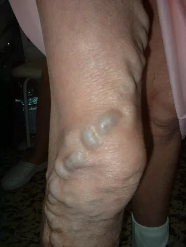 Végtagi visszeresség