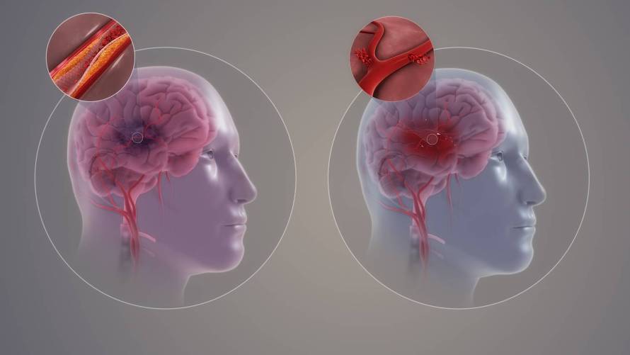 A stroke két formája – grafikus illusztráció