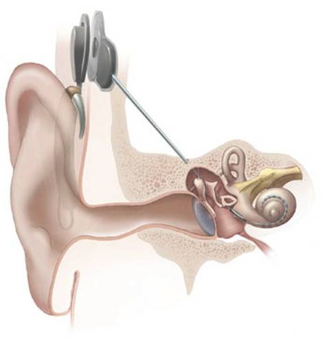 Cochleáris implantátum sematikus ábrán