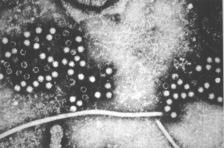 Hepatitisz-E vírusa elektronmikroszkóp alatt