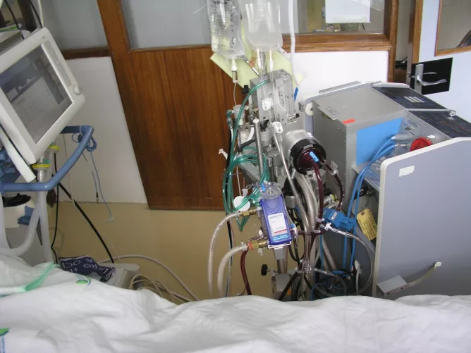 ECMO-eszköz