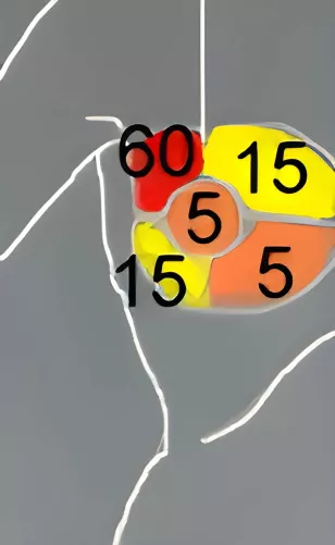 Sematikus ábra az emlődaganat kialakulási helyeiről