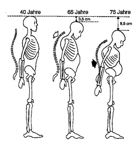 Magasság csökkenése csontritkulásban 65-75 éves korra 