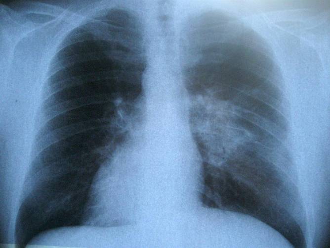 Tüdő röntgenfelvétele (illusztráció)