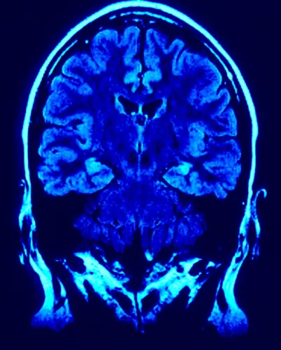 Az agy frontalis metszete képalkotó eszközzel