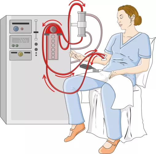 Művesekezelés sematikusan