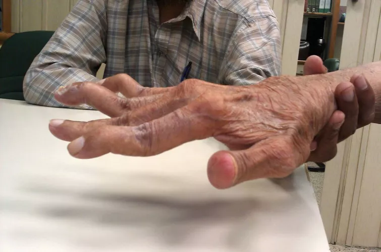 Rheumatoid arthritises kéz