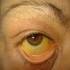 A szem ínhártyájának sárga elszíneződése májbetegségben