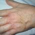 Dermatitisz (bőrgyulladás) a kézen.