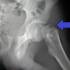 Csípőízületi röntgenfelvétel, combnyaktörés