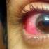 Kötöhártyagyulladás, belövellt szem