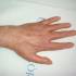 Rheumatoid arthritis kézen