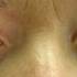 Glaukómás szem