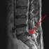 Lumbális gerincsérv MRI-felvételen