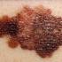 Melanoma malignum