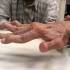 Előrehaladott rheumatoid arthritis kézen 
