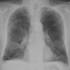 COPD-beteg mellkasi röntgenfelvétele