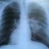 Tüdő röntgenfelvétele (illusztráció)