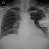 Pacemaker röntgenfelvételen