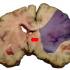 Stroke – agyi metszet